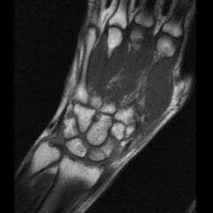 waist fracture of the scaphoid
