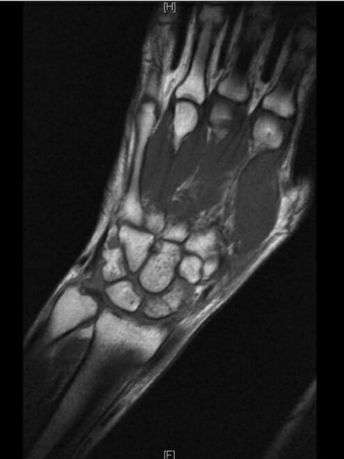Waist fracture of the scaphoid